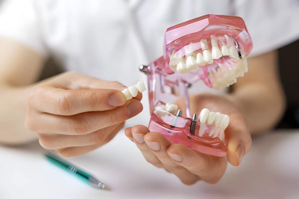 dental implants homepage
